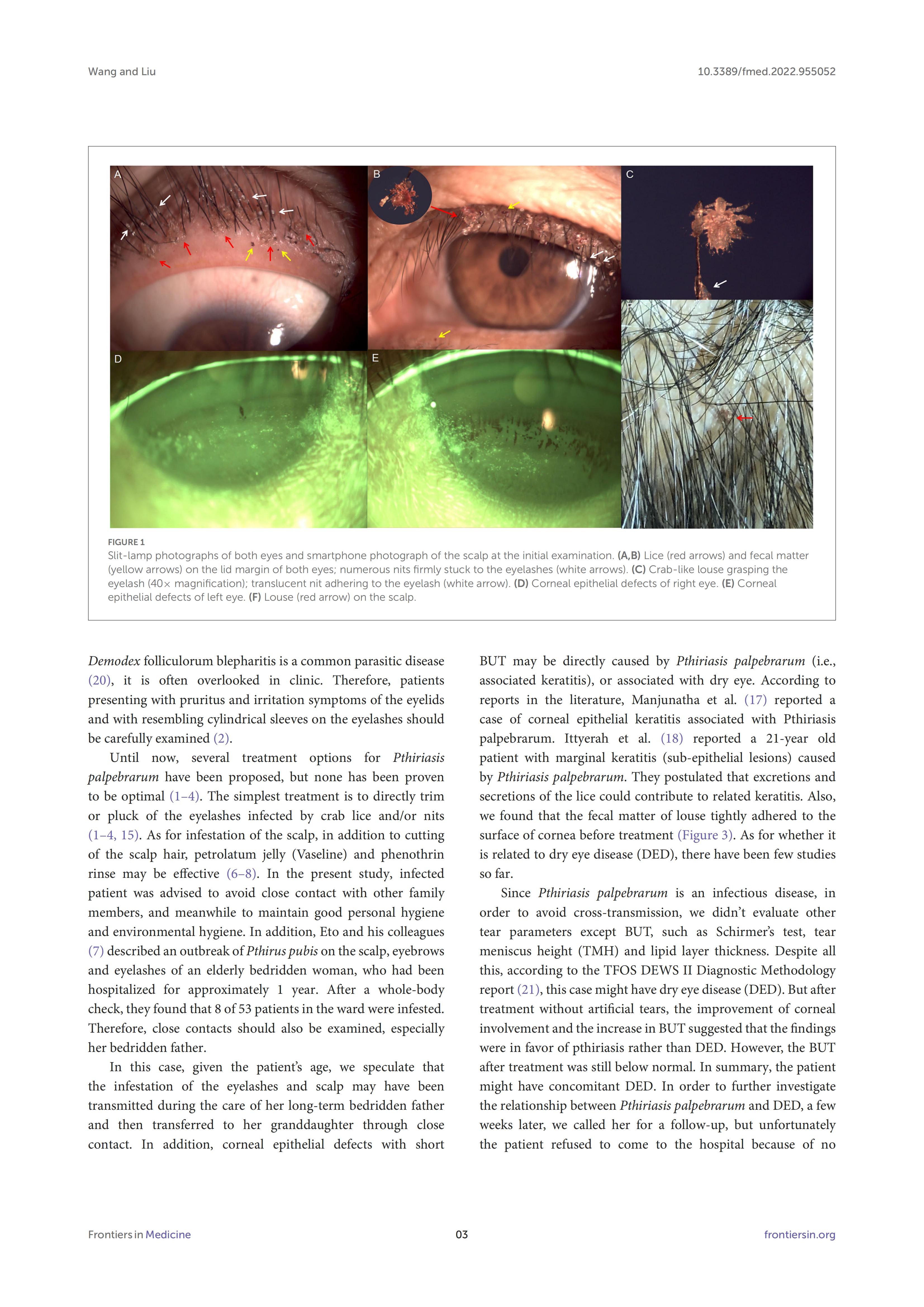 Case report: A case of corneal epithelial injury associated with Pthiriasis palpebrarum